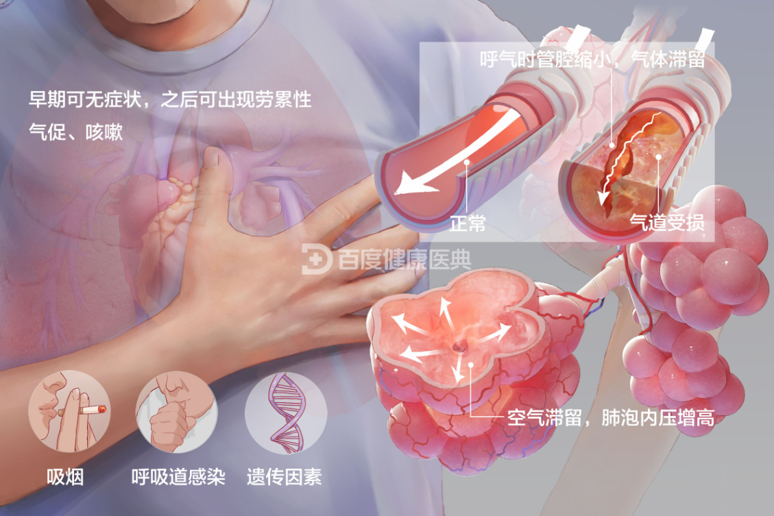 肺气肿有哪些诱发因素，中医对肺气肿有疗效吗？